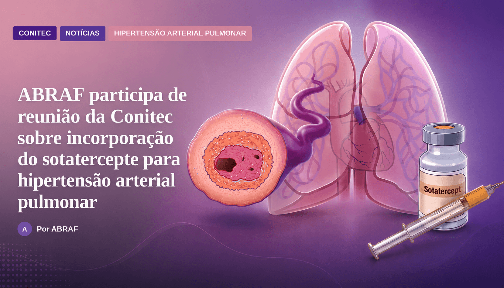 Conitec avaliará a incorporação de Sotatercept para Hipertensão Arterial Pulmonar Thumbnail